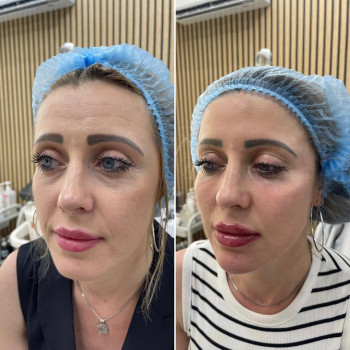 Комплексна корекція обличчя

1️⃣Smas lifting на апараті Ultraformer працювали насадками 3 mm - для...