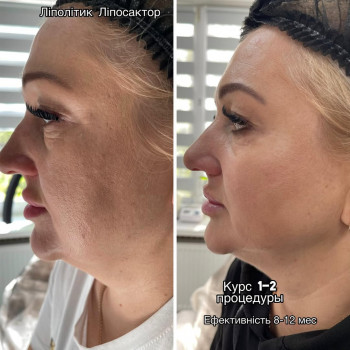 ❗️Цей ліполітік на завжди видоляе жир ❗️
Ліполітик-ліпосактор
ефективність з першої процедури як н...