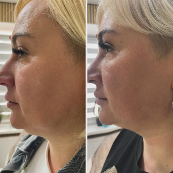 Виконали одну інʼєкційну процедуру в зону другого підборіддя ліполітиком-ліпосактором💉