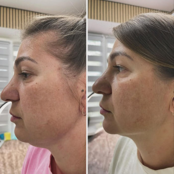 Дія ліполітика-ліпосактора с інтервалом в дві неділі 👌