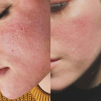 ✅Глибоке шліфування обличчя с різницею в один рік