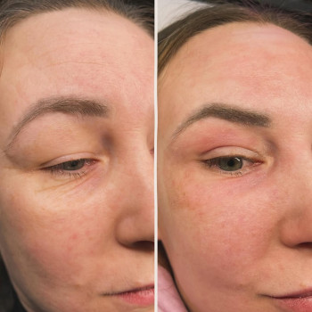 ☑️лазерне шліфування на фракційному лазері со2 периорбитальної зони очей з метою зменшити шкірний ло...