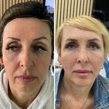 ✅ліфтинг обличчя нитками COG🪡
1місяц після процедури📌