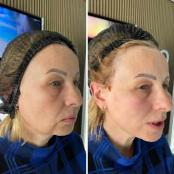 ☑️Нитковий ліфтинг COG
…
Підтяжка обличчя нитками або нитковий ліфтинг – безопераційний метод омол...