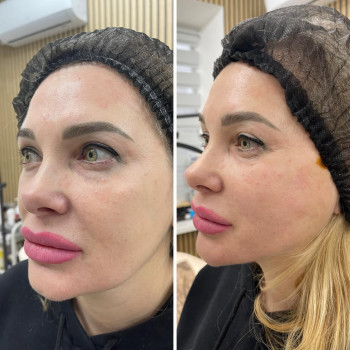 ☑️ліфтинг нитками COG🙌