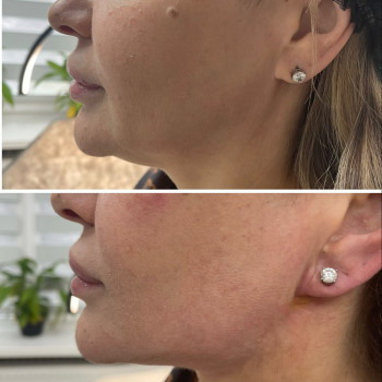 ☑️ ліфтинг підтяжка нитками COG нижньої третини особличчя🪡