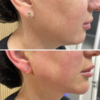 ☑️ ліфтинг підтяжка шийної та підборідних зон нитками COG🪡