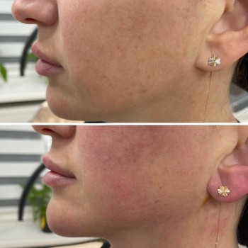 ☑️ ліфтинг підтяжка шийної та підборідних зон нитками COG🪡