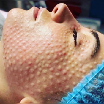 Біоревіталізація