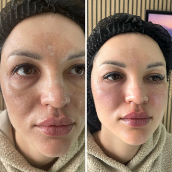 ☑️круто ж плазмогель працює🩸💉
а найважливіше що він не дає ❗️набряків❗️хто боїться і не готовий ляг...