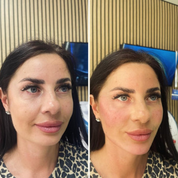 Векторний ліфтинг препаратом Radiesse🔝