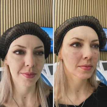 ☑️Radiesse-векторний ліфтинг🔝