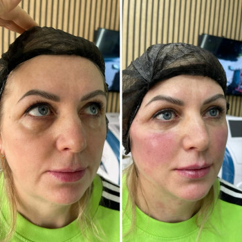 Radiesse- Препарат для ін’єкційної косметології на основі гідроксиапатиту кальцію. Він забезпечує бе...