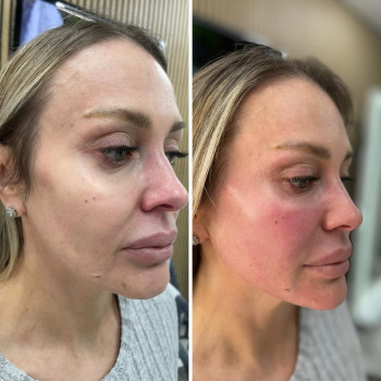 💉🔝векторний ліфтинг препаратом Radiesse
було виконано роботу субпереостально у щочно-вилицьовій зон...