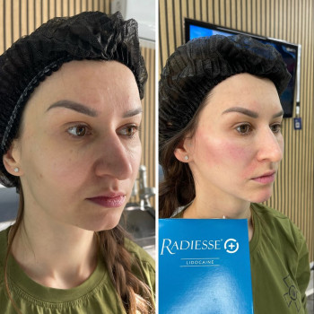 ☑️Radiesse-це є любов🫶