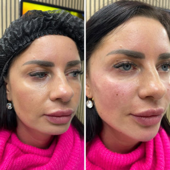 ☑️ Філлер Radiesse - натуральний ліфтинговий наповнювач для заповнення об'єму і стимуляції нового ко...