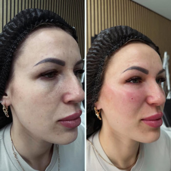 ☑️попрацювали с дефіцитом обʼєму в срединій третині обличчя препаратом Facetem , виконуються одна пр...