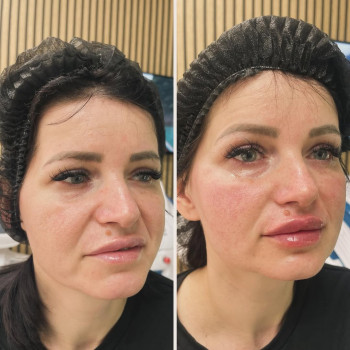 Facetem S (Корея) - інноваційний інтрадермальний філер на основі гідроксиапатиту кальцію для волюміз...