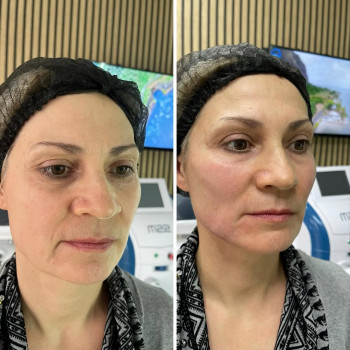 ✅Facetem – новинка у світі косметології. Даний препарат зроблений на основі гідроксиапатиту кальцію...