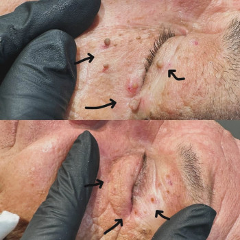 Видалення новоутворень