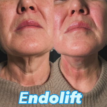 Endolift