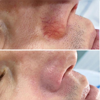 Коагуляція судинної сітки