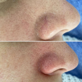 Коагуляція судинної сітки