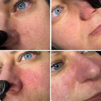 Коагуляція судинної сітки