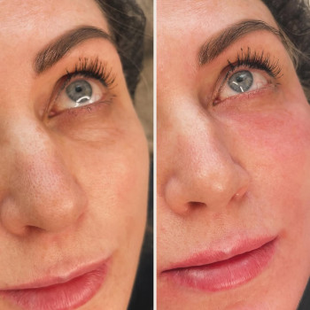 Заповнення носослізної борозди плазмогелем