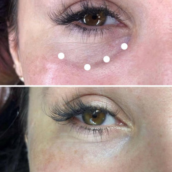 заповнення нососльозної борозни плазмогелем💉