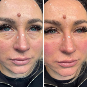 корекція нососльозної борозни плазмогелем🩸