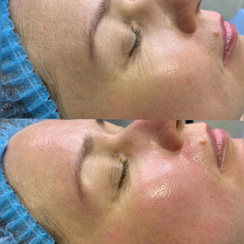 ✅ Ферментотерапія - інноваційна процедура, має спеціальну дію, викликає потужну стимуляцію м'язів і...