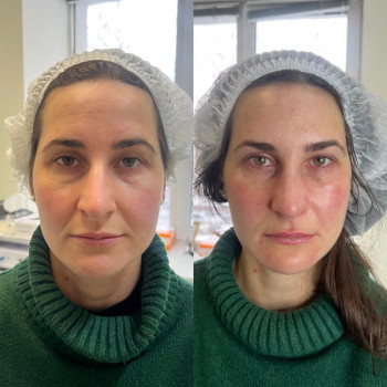 Комплексная работа: между до и после 3 процедуры., фото - косметолог Маргарита Перченко