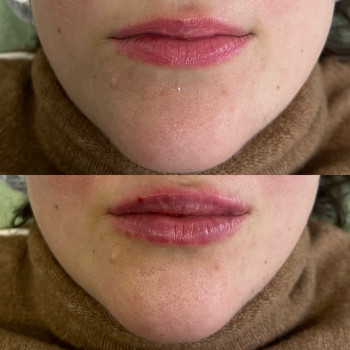 Контурная пластыга губ, фото - косметолог Маргарита Перченко