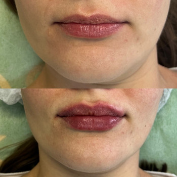 Контурная пластика губ, фото - косметолог Маргарита Перченко