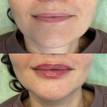Контурная пластика губ, фото - косметолог Маргарита Перченко