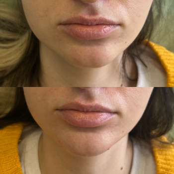 Контурная пластка подбородка, фото - косметолог Маргарита Перченко