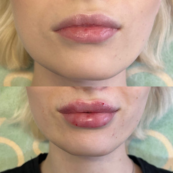 Контурная пластика губ, фото - косметолог Маргарита Перченко