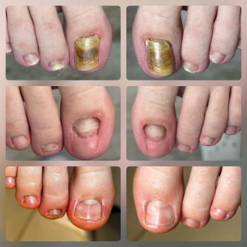  #оніхомікоз #грибокногтей #грибокнаногтях