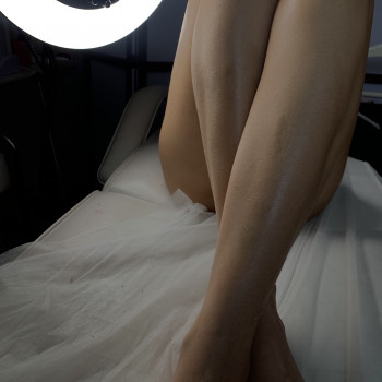 Корекція врослого волосся/ Інтимне відбілювання
                    Мастер депиляции  Тернополь