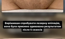 Лазерная эпиляция Викладач курсів краси Анна Дніпро