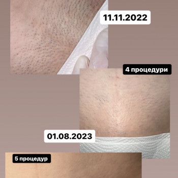 Лазерна епіляція
                    Викладач курсів краси Анна Дніпро