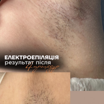 Електроепіляція
                    Викладач курсів краси Анна Дніпро