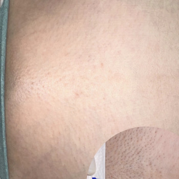 Результат після лазерної епіляції 8 процедур