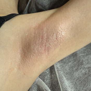 Воскова депіляція
                    Мастер депиляции  Киев