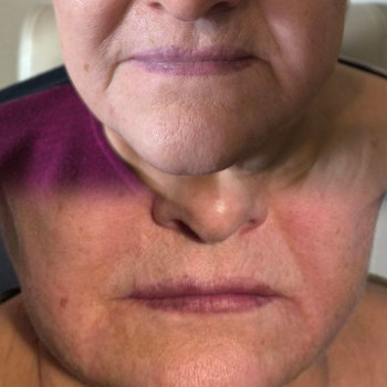 Так же результат использования Miore Mesolift