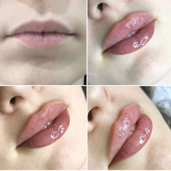 ✨ Первинне збільшення губ — це не просто про об’єм. Це про гармонію, природність і впевненість у соб...