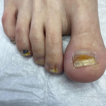 Пацієнт був направлений дерматологом для видалення уражених псоріазом нігтів та подальшої спільної т...