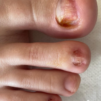 Подологічна обробка нігтів при псоріазі
