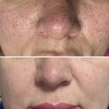 Видалення на IPL, фото - косметолог Ольга Мельник